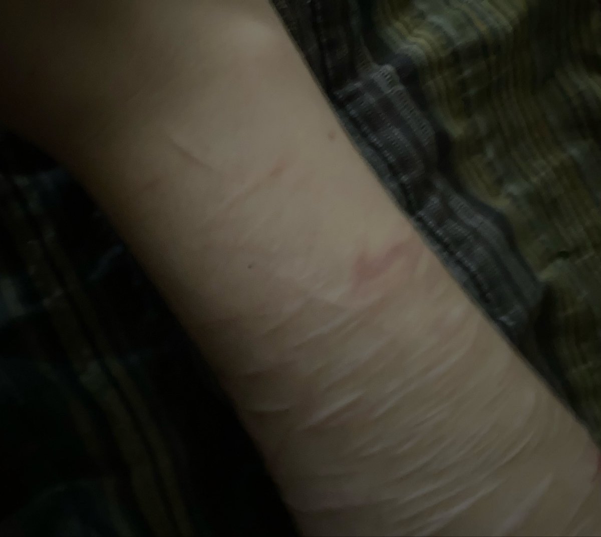 eIfglrl's tweet photo. Car Crash Scars :// Not real dont take down !!’ These r Scars #sfxmakeup #sfx #shrtwt #slittwt https://t.co/DA6yX3pWZm