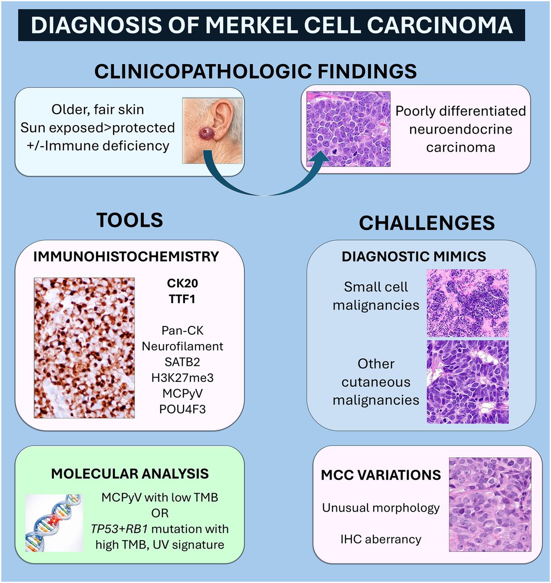 StainsFile's tweet photo. 💡 New review alert from Dr. Paul Harms at @UMich!

This review details pitfalls and nuances for Merkel cell carcinoma (#MCC) diagnosis, including an updated differential diagnosis: https://t.co/9j0kDsLLzX

#Immunohistochemistry https://t.co/xe1WjjKf39