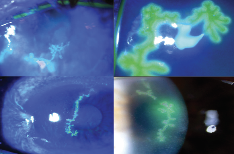 revoptom's tweet photo. Herpes Simplex or Herpes Zoster? Know the Differences That Matter

Their ocular manifestations can look deceptively similar, but differences in lesion morphology, treatment, recurrence and complications have important consequences for patient care.
https://t.co/o5XMyFBYrt

#cornea #optometry #eyecare