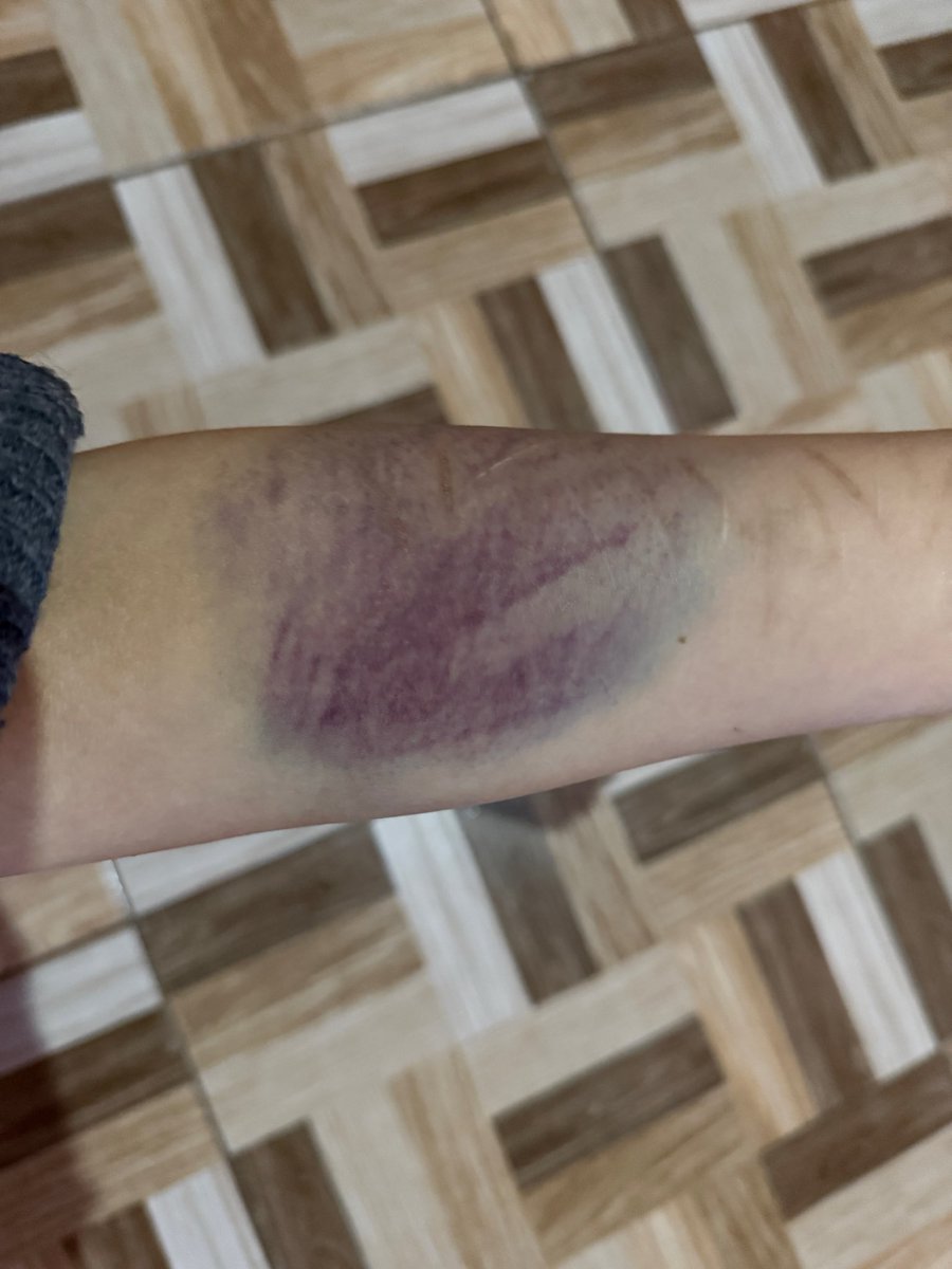 kasumiwyn's tweet photo. #bruisespo #bruisetwt #subtwt https://t.co/QMiU2pyXfu