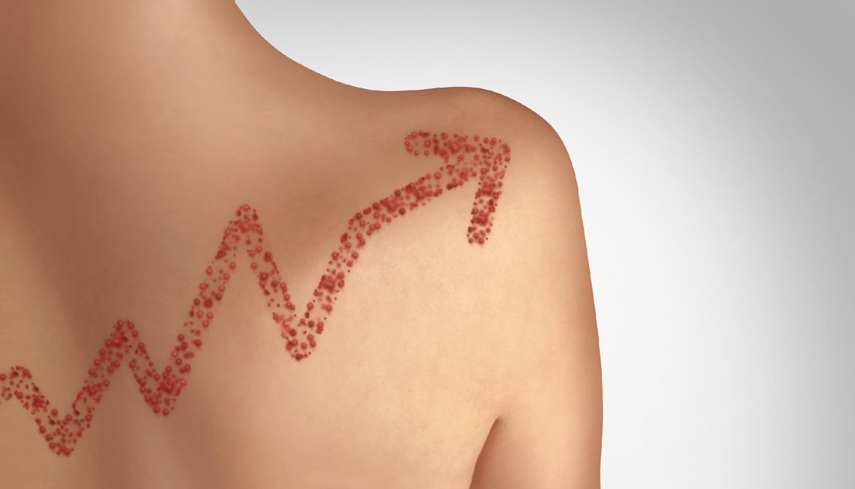 CIDRAP's tweet photo. US measles cases hit 4,588, more than twice last year’s total

Pennsylvania remains the US hot spot, accounting for nearly 30% of the country’s cases.

Read more: https://t.co/UiaDs79k8z https://t.co/ZStUM2En31