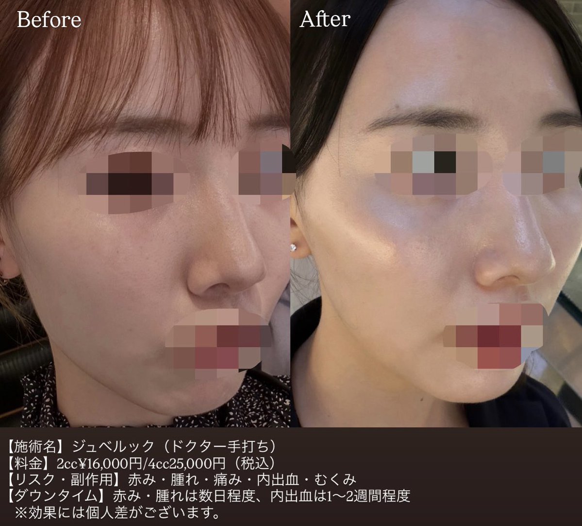 aloeclinic's tweet photo. 引用失礼します🙇‍♀️
ジュベルックのビフォアフと解説貼ります。

美容クリニックのスタッフ人もジュベルックは正直1番効果感じてる治療です。
生まれたてのようななめらかなつるんとした肌になりたい方にお勧めします。
肌綺麗だねと言われる機会が冗談なしに本当に増えます。

また毛穴引き締めににピコダブルを組み合わせるとなめらかさがプラスされてさらに綺麗になります。

・ジュベルックドクター手打ち
2cc¥16,000円/4cc25,000円（税込）
・ピコダブル
8,000円（税込）