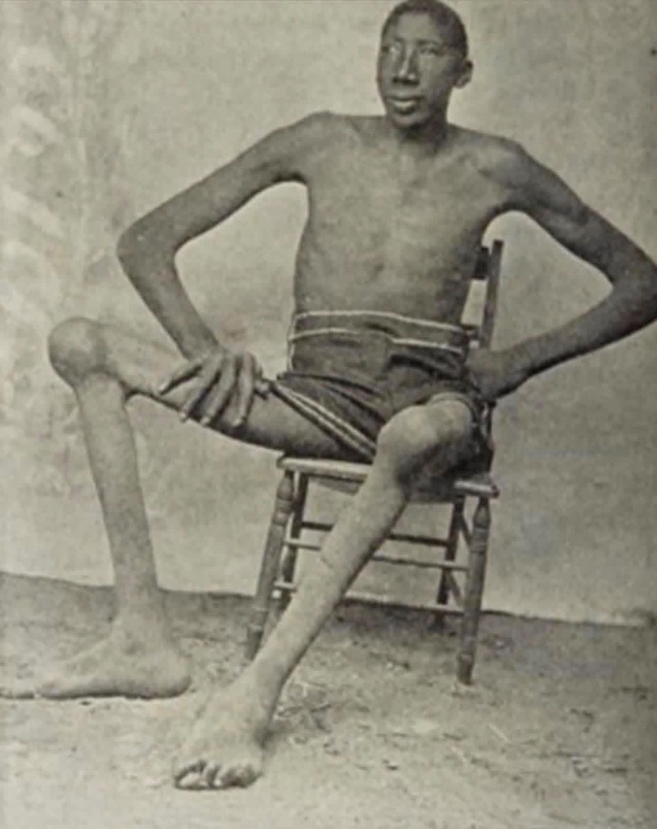 Iam_dTreasure's tweet photo. Even after he died, his family feared that people would try to take his body. So, they covered his grave with concrete.

His name was John William “Bud” Rogan, a man remembered as the tallest person of African descent ever recorded.

Born in Tennessee in 1868, just three years after slavery ended in America, Rogan lived a life few could have imagined. At thirteen, he began growing at an unusual rate. By adulthood, he stood among the tallest men in history, measuring about 8 feet 8 inches while seated.

But his extraordinary height came with painful challenges. His joints gradually stiffened until he could no longer stand or walk on his own.

At a time when people with unusual physical conditions were often displayed in traveling shows for entertainment, Rogan refused to become a spectacle. He turned down opportunities to make money by putting his body on display.

Instead, he found his own way to survive. He built a cart from his bed, used goats to pull it, and taught himself to draw. He sold sketches, portraits, and postcards at a local railway station, earning what he could through his artwork.

Life was difficult, but he held on to his dignity.

In 1905, at just 35 years old, Bud Rogan died from complications related to his condition.

Even then, his family had another worry.

At the time, Black people’s remains were often stolen from graves and used for medical examinations without the family's permission. Fearing that Rogan might suffer the same fate, his family took steps to protect his body.

They had his grave covered with concrete.

It was not about shame. It was about making sure he could finally rest without being disturbed or exploited.

Bud Rogan's life was about much more than his height. It was the story of a man who faced enormous physical challenges, refused to let others turn him into entertainment, and found a way to earn a living on his own terms.

He was more than his appearance.
More than a medical curiosity.
More than a name in the history books.

He was a man who deserved to be treated with respect, just like anyone else.

And when the world could not guarantee him that dignity in life, his family did everything they could to protect it in death.