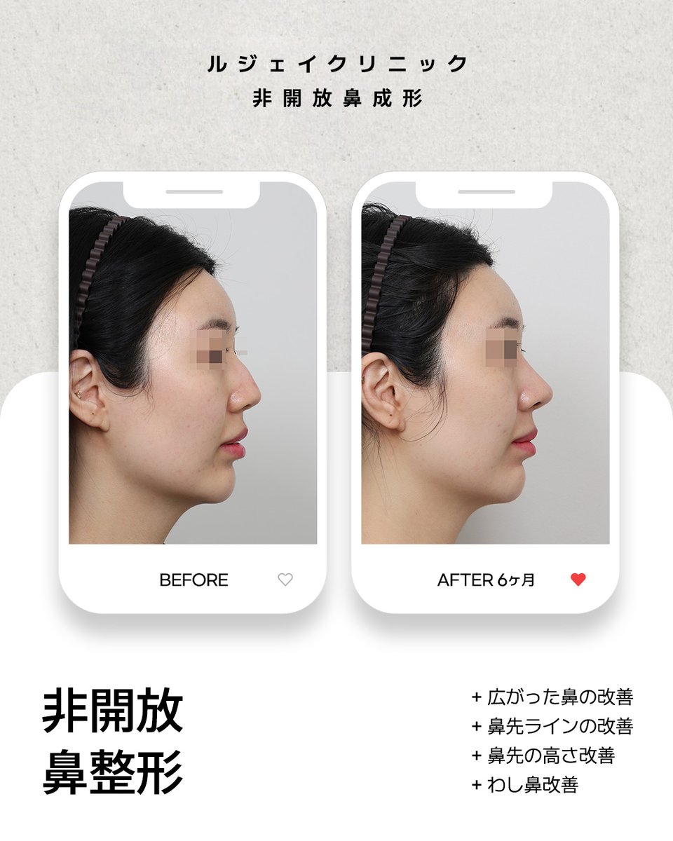 lejclinic's tweet photo. 鷲鼻・矢印鼻・団子鼻など、一人ひとりの鼻のお悩みに合わせたクローズ法による鼻整形！ルジェイクリニックのクローズ法による鼻整形は、鼻��の外側を切開せず、鼻の内側からアプローチし、一人ひとり異なる鼻の構造や軟骨の状態を考慮しながら、それぞれのお悩みに合わせた手術方法を計画します。 https://t.co/MLOW4Fna1W