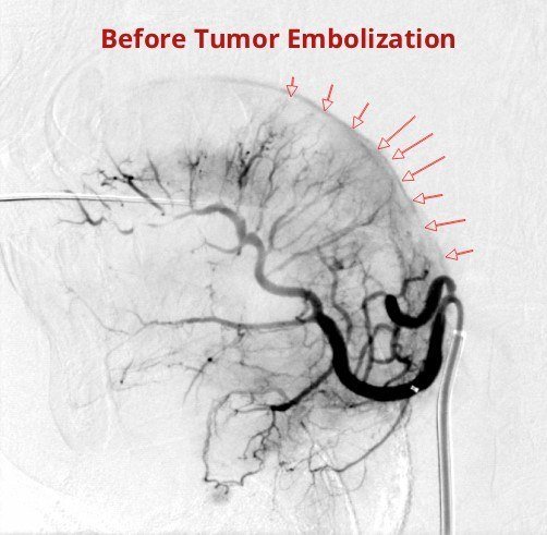 axon_stroke's tweet photo. 🇪🇹 A First for Ethiopia!

#AxonStrokeAndSpineCenter performed Ethiopia’s first-ever #TongueTumorEmbolization on a 39 yr old patient using advanced micro-catheter techniques, Onyx, and micro-coils.

👏 Credit to Dr. Demerew Dejene for the referral and successful tumor excision. https://t.co/HLZwWXjtb3