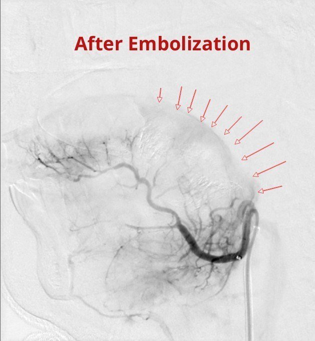 axon_stroke's tweet photo. 🇪🇹 A First for Ethiopia!

#AxonStrokeAndSpineCenter performed Ethiopia’s first-ever #TongueTumorEmbolization on a 39 yr old patient using advanced micro-catheter techniques, Onyx, and micro-coils.

👏 Credit to Dr. Demerew Dejene for the referral and successful tumor excision. https://t.co/HLZwWXjtb3