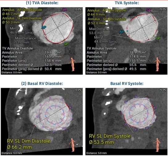 PCRonline's tweet photo. TTVR or T-TEER? When anatomy doesn't tell the whole story

Part 1⃣ https://t.co/lRae7TpqTc

An 85-year-old woman with severe TR, symptomatic heart failure and reduced right ventricular function presents a challenging transcatheter treatment decision. 

Although the tricuspid anatomy appears favourable, several clinical factors - including impaired RV–PA coupling, pre-existing LBBB, thrombocytopenia and concomitant mitral regurgitation - add complexity to the choice of strategy.

View part 1⃣ of this case shared by Lisa Kettler : would anatomy alone be enough to guide the decision?

#interventionalcardiology #CardioEd #TreatTR