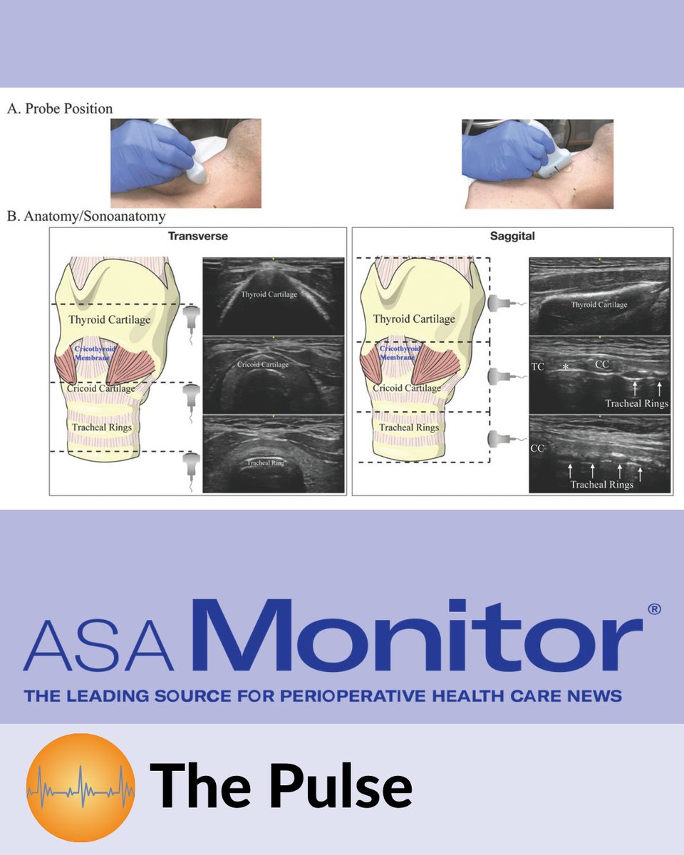 ASAMonitor's tweet photo. In 2027, ultrasound assessment of airway anatomy will be added to the Objective Structured Clinical Examination component of the APPLIED Exam, expanding the role of POCUS, especially for early-career anesthesiologists. 

Learn more: 
https://t.co/324ie5JqTm https://t.co/Z4u8S4b0kx