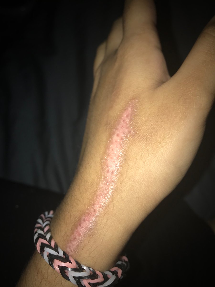 silkym0nster's tweet photo. 2024 vs now…I hate when scars fade 😢 I rlly liked this one too

If ur wondering why the camera quality is so different the first pic is from like a second hand iPhone 7 and second pic is an iPhone 13 and I also some lost weight idk https://t.co/M0LgpuD4bF