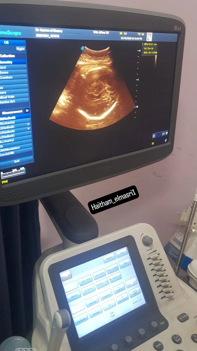 HaithamElmasri1's tweet photo. 🚨 My wife's life and her pregnancy are now in danger.

My wife is suffering from malnutrition due to the lack of healthy food, including vegetables, meat, fruit, and clean drinking water.

As a result, her baby weighs only 1.5 kilograms, even though she is now at the end of her eighth month of pregnancy. This places both her life and her baby's life in a critical condition.

Today, the doctor urgently prescribed treatments rich in vitamins, protein, and minerals, along with foods rich in these essential nutrients, so that her baby can benefit from as much nourishment as possible, improve his health, and gain weight before his expected birth on November 26, 2026.

That is why we need you now more than ever. This is about my wife's life and my child's life, and trying to save them from the danger that threatens them every moment.

Every donation, no matter how small, will help us provide the food, clean water, medication, and medical care they need to protect their health. We have only a few days left, and time is running out as our fears for their lives continue to grow.

I beg you, from the bottom of my heart, please do not hesitate to donate and share our campaign.

Your support could be what we need to save my wife and child and give them a chance to survive.🥹🙏
https://t.co/XCHmJKrRCR