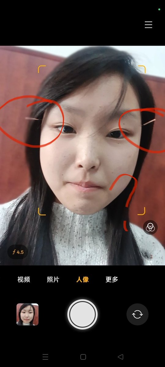 ezb3666's tweet photo. 做完针灸又做电疗了，真的懵 https://t.co/Pu3l44NR64