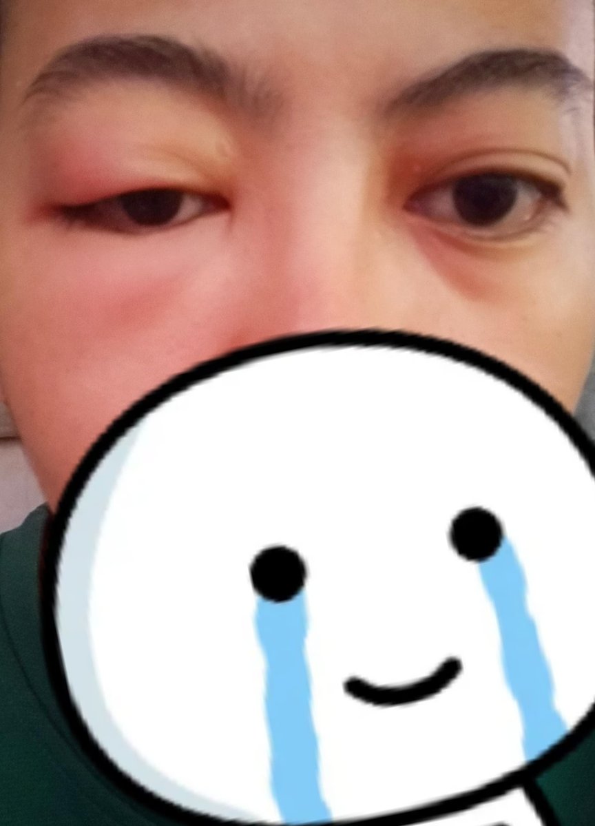 28zero190's tweet photo. Bgn² tido tnjuk kt hby "tgk ni" .. Hby ckp "ok ape..comel lg tuu, hahahaa mcm org bru lpas kluar dr gelanggang tinju..kahkah, bengkak je gitu kne tmbuk" 
Hmm gelak gelakk la dlu eh cukks😌
Sy ok ,tkdehal😌 https://t.co/OaqBmHzDQj