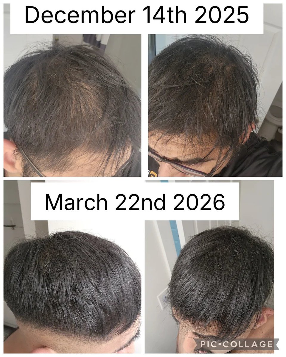 PeptitRadar's tweet photo. GHK-Cu: Cilt ve saç bakımında radarınıza almanız gereken bakır peptit!

Daha pürüzsüz görünen bir cilt, daha canlı bir görünüm, parlak ve bakımlı saçlar… GHK-Cu’yu bu kadar merak edilir yapan potansiyel tam olarak bu.

Bakır Peptit (GHK-Cu), anti-aging dünyasının şu anki en güçlü silahı:

✅ Kırışıklık ve leke görünümünde gözle görülür azalma, 
✅ Saç folikülü boyutunda büyütme ve daha gür görünüm ,
✅ Cilt bariyerinde maksimum onarım,
Before/After görselleri her şeyi özetliyor.

#GHKCu #CopperPeptide #CiltBakımı #SaçSağlığı #Peptit