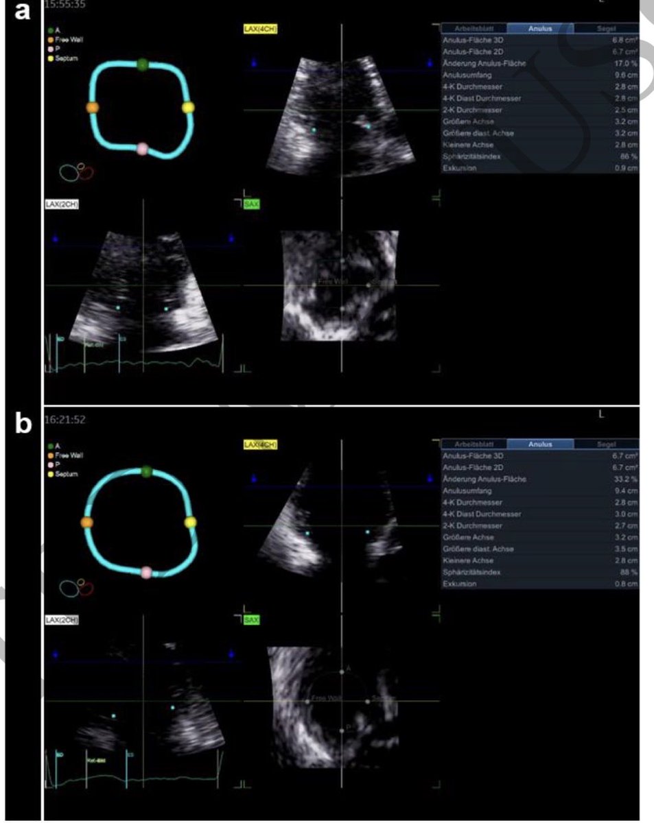 NMerke's tweet photo. #echofirst case report about functional TR non atrial nor ventricular 
👉 https://t.co/wJRy7n3f5w
@dr_benoy_n_shah @echo_batman @echo_stepbystep @StellEkaterina https://t.co/ZpSO4E4afq