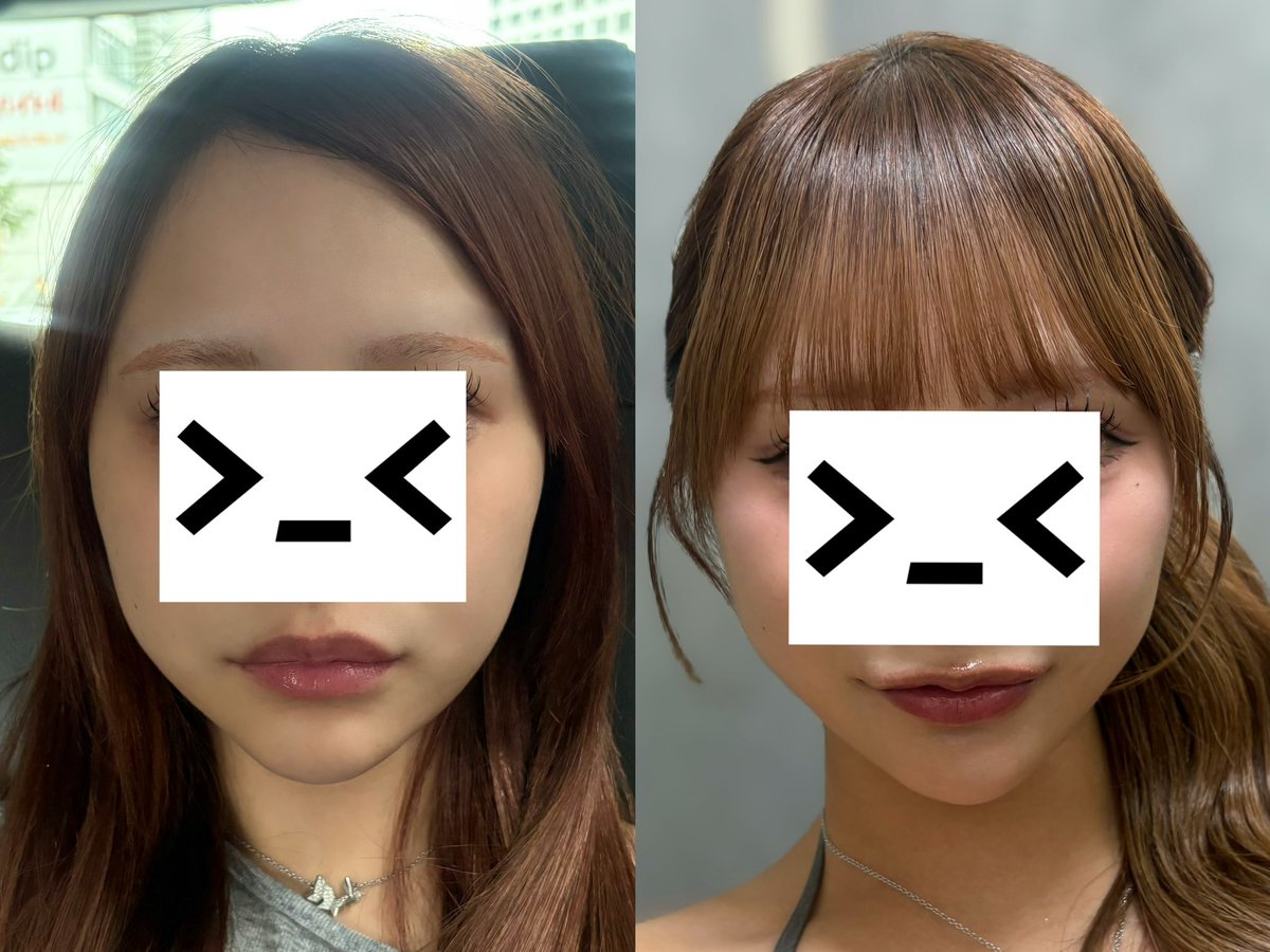 chan049_yy's tweet photo. これですよね！
ルサンククリニックで入れ放題99000円だったwうますぎ安すぎでびびった https://t.co/qwbNyHjLqf