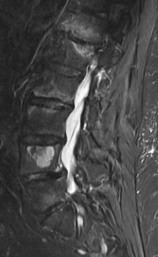 francisdeng's tweet photo. Malpractice case: lumbar spinal mass, $1M verdict.

Take a look at these MR images from a separate teaching case of the same pathology and site as the litigant. https://t.co/pwTdEWt3xf