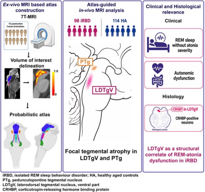 ScienceofPD's tweet photo. Researchers present evidence for the involvement of laterodorsal tegmental nucleus-ventral part (the putative human homologue of the murine sublaterodorsal nucleus) in isolated REM sleep behaviour disorder (Structural MRIs; n=98 iRBD &amp; 114 controls)
https://t.co/qiREyyofgr https://t.co/yubdbjfEMC