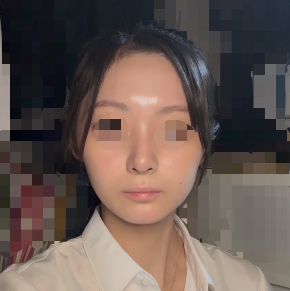 Db3r2vtVLw27685's tweet photo. 正面から見たらコレ
iPhoneカメラの動画で撮ったやつスクショした

まだまだ鼻先丸いし、なりより以前と違いすぎて違和感。
唇色ないし薄すぎるwww https://t.co/U4OT8Kzdh9