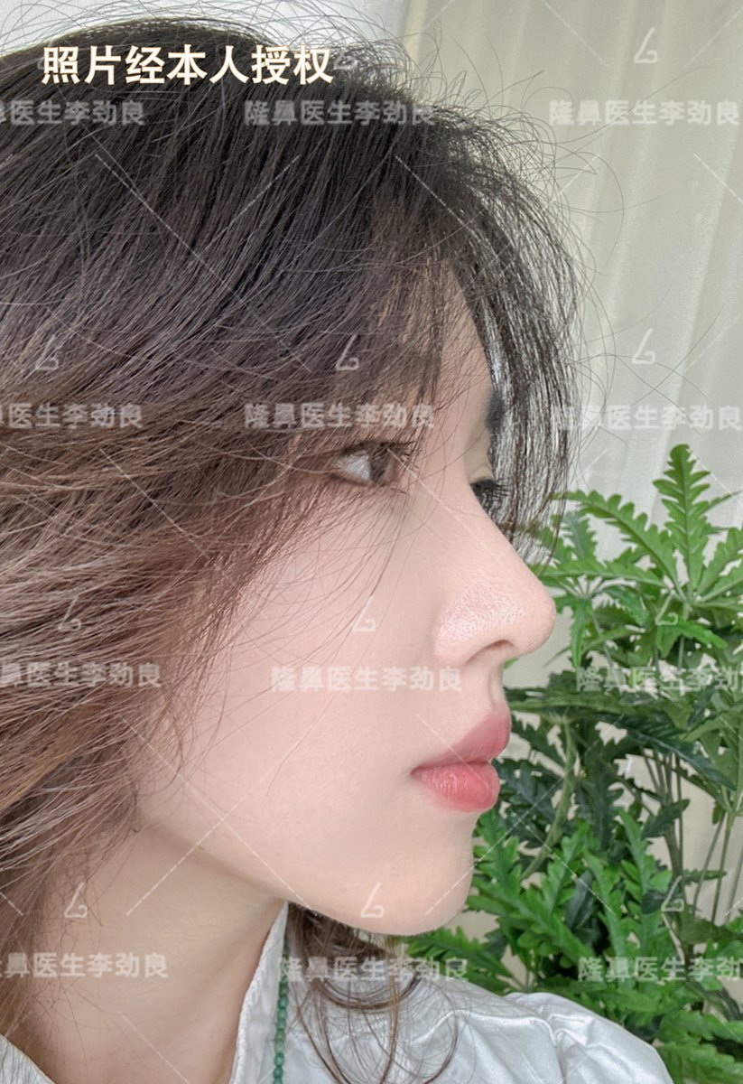 kdr098's tweet photo. [今回の手術では娜氏鼻沧技術を使用し、自然な仕上がりになりました]， https://t.co/KhV3dodyz2