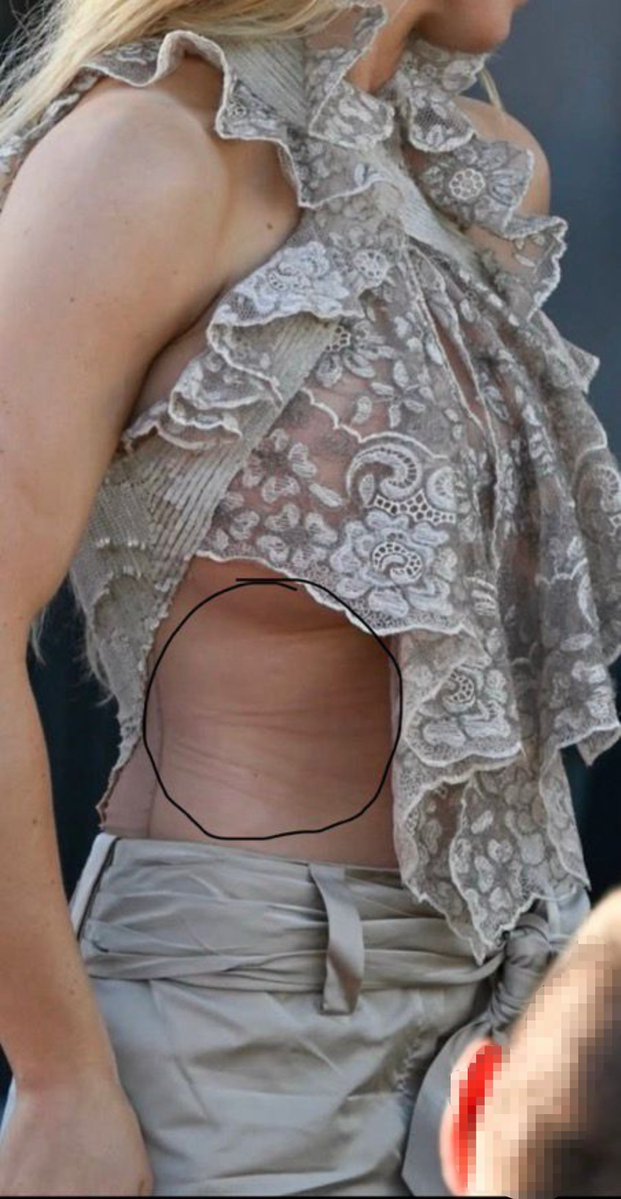 Stevetweetzz1's tweet photo. Hey @grok ,can you explain what that circled mark on Syndey Sweeney's ribs actually is?👀🤔 https://t.co/QKDwjkChj6