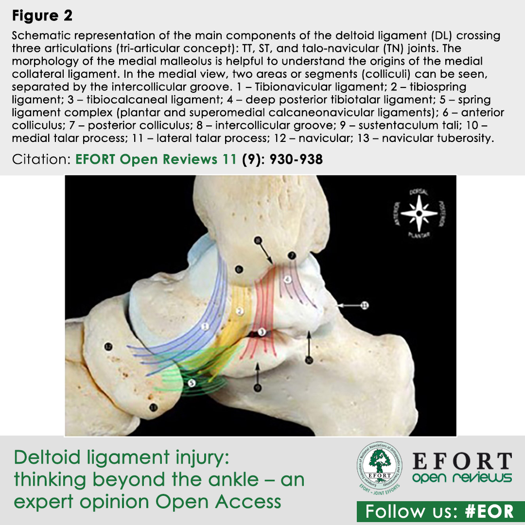 EFORTnet's tweet photo. Thinking beyond the #AnkleJoint: How do you manage #DeltoidLigamentTears in #AnkleFractures?
#EFORT #EOR highlights #DiagnosticProtocols & #SurgicalCriteria to treat #MedialInstability & prevent #PostTraumaticArthritis
π https://t.co/C72lENtoCe
#Orthopaedics #SportsMedicine https://t.co/1zjEyyqlXm