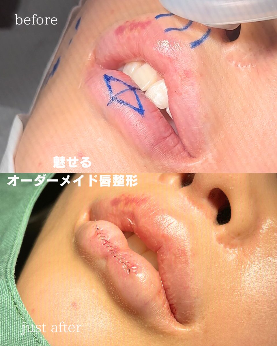 prism_morimoto's tweet photo. 切開系の施術が多いイメージを持たれがちですが、実は唇のヒアルロン酸注入も、切開手術以上に毎日行っています。

ヒアルロン酸注入を得意とする医師は多くても、切開手術まで得意とする医師は限られます。

切開も、注入も。どちらも得意だからこそ、選択肢を狭めずにご提案できます。
↓ https://t.co/GSxHSubyKv