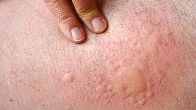 Aller_MD's tweet photo. #Omalizumab Tied to Lower #Heart Disease Risk in #Chronic #Spontaneous #Urticaria: Patients with chronic spontaneous urticaria treated with omalizumab have a lower cardiovascular disease risk than those treated with oral corticosteroids or antihistamines. https://t.co/bFkpXM2AJZ https://t.co/6qWAk4QvBd