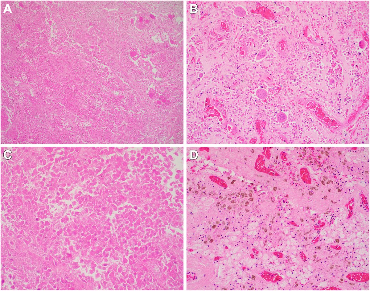 Human_Pathology's tweet photo. New in #HumPathol: Infarcted Tenosynovial Giant Cell Tumors: Multi-Institutional Analysis of 80 Cases Highlighting Consultation Patterns and Diagnostic Challenges. https://t.co/OU7YrFzzaY #pathology #PathTwitter #PathX #BSTpath https://t.co/GFe4LkFd0f