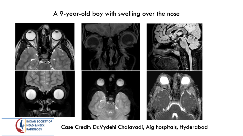 teamishnr's tweet photo. #caseoftheweek
What are the findings and DDx?
The answer will be uploaded Thursday
#radiology #caseoftheweek #headandneck #radiologycases #ISHNR #teaching #imaging
Visit our website: https://t.co/mk5Cy7vBSS https://t.co/NSCWauAehK