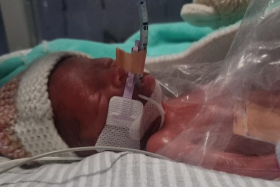 LifeNewsHQ's tweet photo. This is baby Emmie.  Born at 25 weeks.

Emmie isn't tissue, a parasite or a clump of cells.  

She's a human being. https://t.co/509rjToSL4