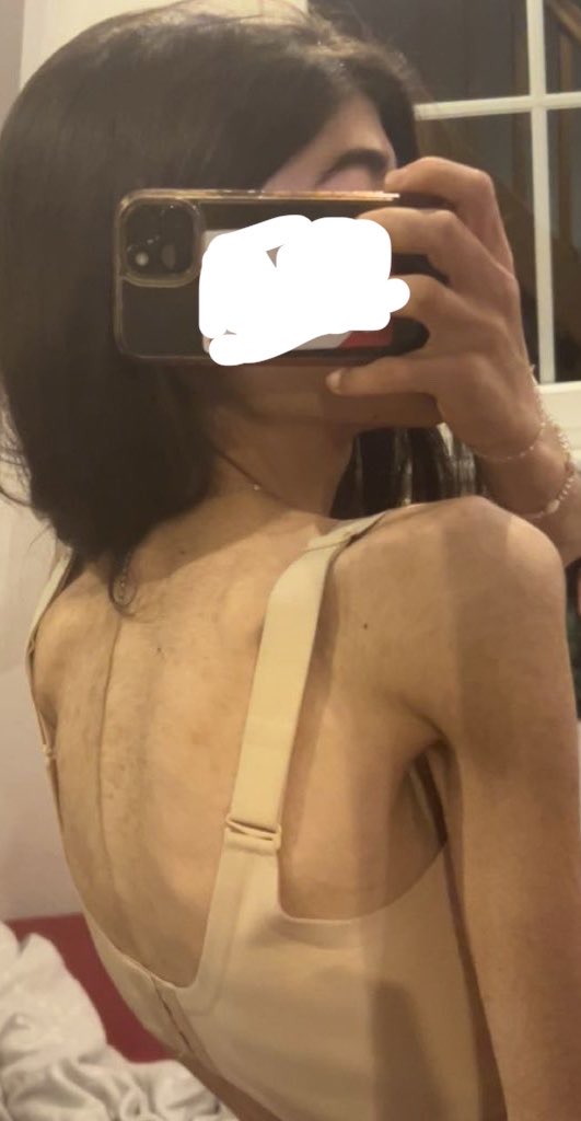 arisharawrs's tweet photo. Me at my lw btw😔... UGH I miss it ( gained ~20lbs in forced recovery...)
#edrtwt #anatwt #bodycheck #bonespo https://t.co/Lxl7CKEYDm
