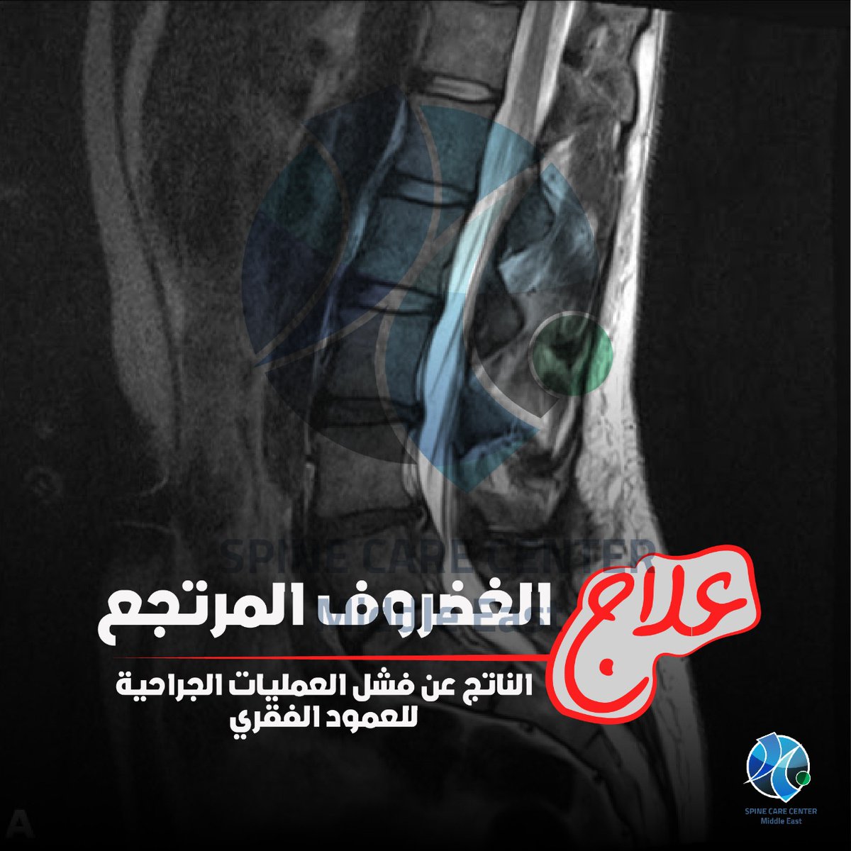 basemhenri's tweet photo. 🦴 الغضروف المرتجع وآلام ما بعد عمليات العمود الفقري | FBSS
هل أجريت عملية في العمود الفقري، سواء لاستئصال الغضروف أو تثبيت الفقرات، وما زلت تعاني من ألم الظهر أو الساقين؟ 🤔

الحالة دي ممكن تكون مرتبطة بمتلازمة جراحات العمود الفقري غير الناجحة (FBSS)، وهي حالة يستمر فيها الألم أو يعود بعد الجراحة، ولها أسباب متعددة، منها:

🔹 الالتصاقات حول الأعصاب: قد تتكوّن أنسجة ليفية بعد الجراحة وتساهم في استمرار الألم.

🔹 تغيّر ميكانيكية حركة العمود الفقري: ممكن يسبب ضغطًا إضافيًا على مفاصل الفقرات أو المفصل العجزي الحرقفي.

🔹 استمرار السبب الأصلي للألم: أحيانًا لا يختفي مصدر الألم بالكامل بعد العملية.

🔹 عودة الانزلاق الغضروفي: قد يحدث انزلاق جديد في نفس المستوى بعد الجراحة.

🔹 ظهور مشكلة جديدة: مثل ضيق القناة العصبية أو مشكلات أخرى بالفقرات والأعصاب.

💡 هل استمرار الألم يعني ضرورة إجراء عملية أخرى؟
مش بالضرورة! الحل يبدأ بتحديد السبب الحقيقي للألم من خلال الفحص ومراجعة الأشعة والتاريخ المرضي، وبعدها يتم اختيار العلاج المناسب لكل حالة. وقد تكون هناك خيارات علاجية بالتدخل المحدود لبعض المرضى، حسب التشخيص.

💙 لو الألم رجع بعد عملية العمود الفقري، ما تتجاهلوش.. التشخيص الدقيق هو أول خطوة لاختيار العلاج المناسب.