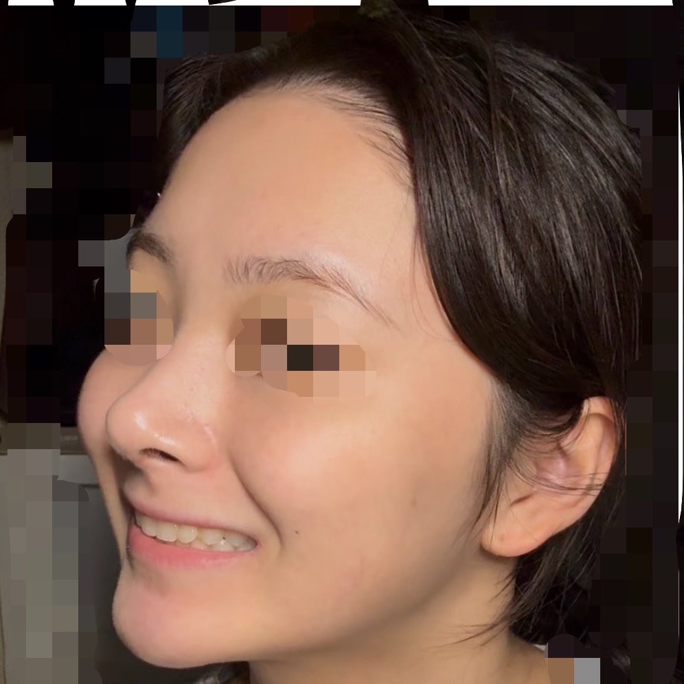 Db3r2vtVLw27685's tweet photo. 猫手術(鼻唇角矯正・鼻柱矯正)の真実

人前で笑えなくなります
「牛の輪っか」みたいになります
＊術後もうすぐ3ヶ月

ダウンタイム終わったら無くなることありますか？ https://t.co/RswBQuPYZi
