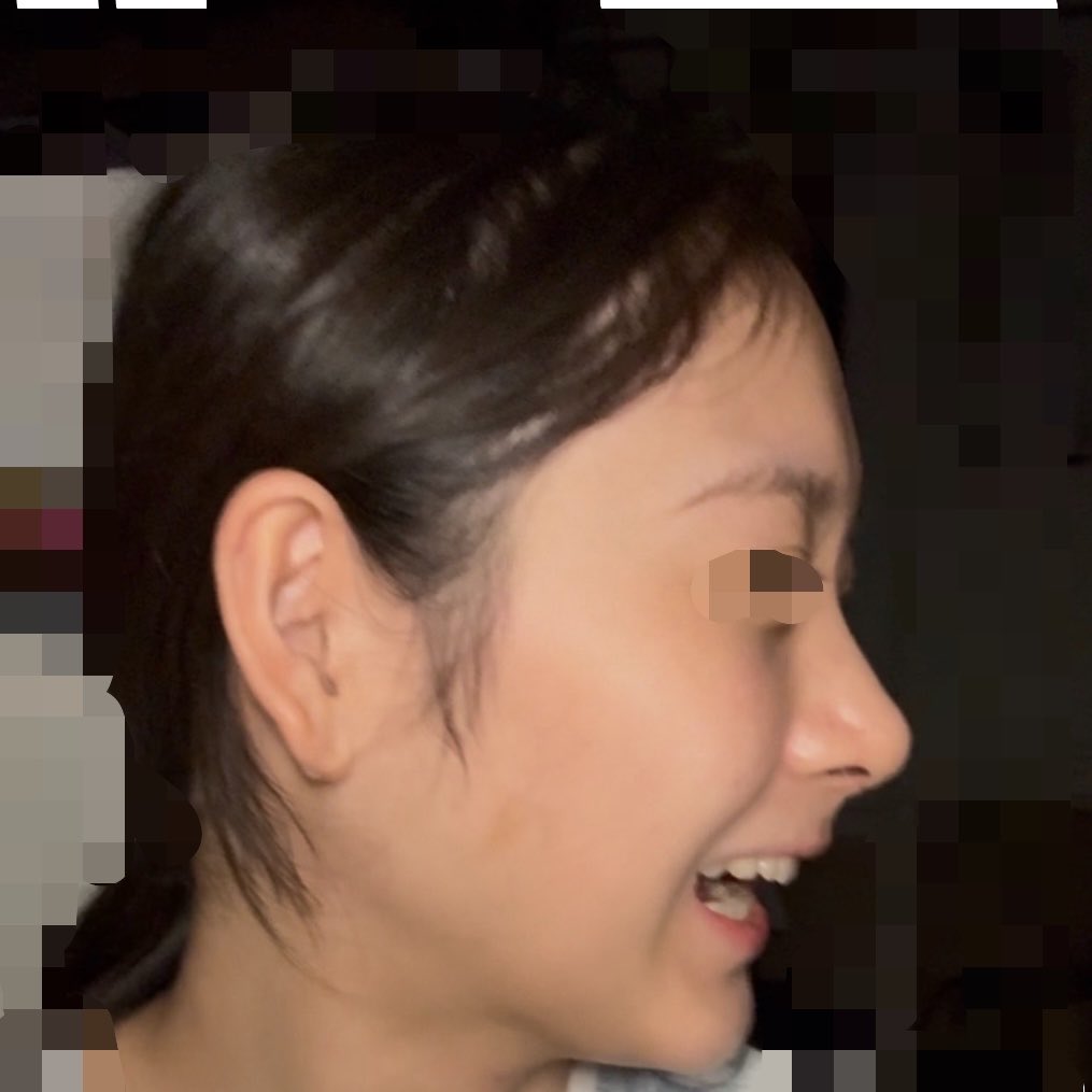 Db3r2vtVLw27685's tweet photo. 猫手術(鼻唇角矯正・鼻柱矯正)の真実

人前で笑えなくなります
「牛の輪っか」みたいになります
＊術後もうすぐ3ヶ月

ダウンタイム終わったら無くなることありますか？ https://t.co/RswBQuPYZi