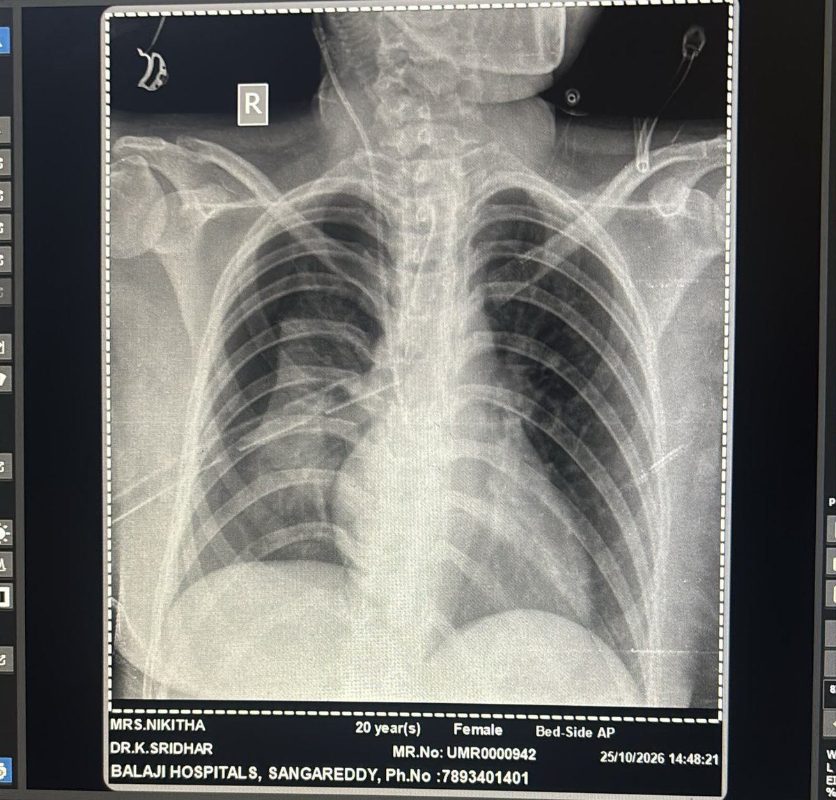 TheRealPKFan's tweet photo. 🙏 URGENT HELP NEEDED | PLEASE SHARE 🙏

20-year-old Nikitha met with a serious accident and sustained a severe brain injury. Her MRI and CT reports show brain hemorrhages and Diffuse Axonal Injury (DAI). She is currently undergoing treatment.

Her family has already spent around ₹5 lakhs on her treatment and is now unable to afford further medical expenses. 

🙏 Please help Nikitha. Every contribution matters. Kindly share.

📲 PhonePe / Google Pay: 9502480084

Your support can make a difference. ❤️