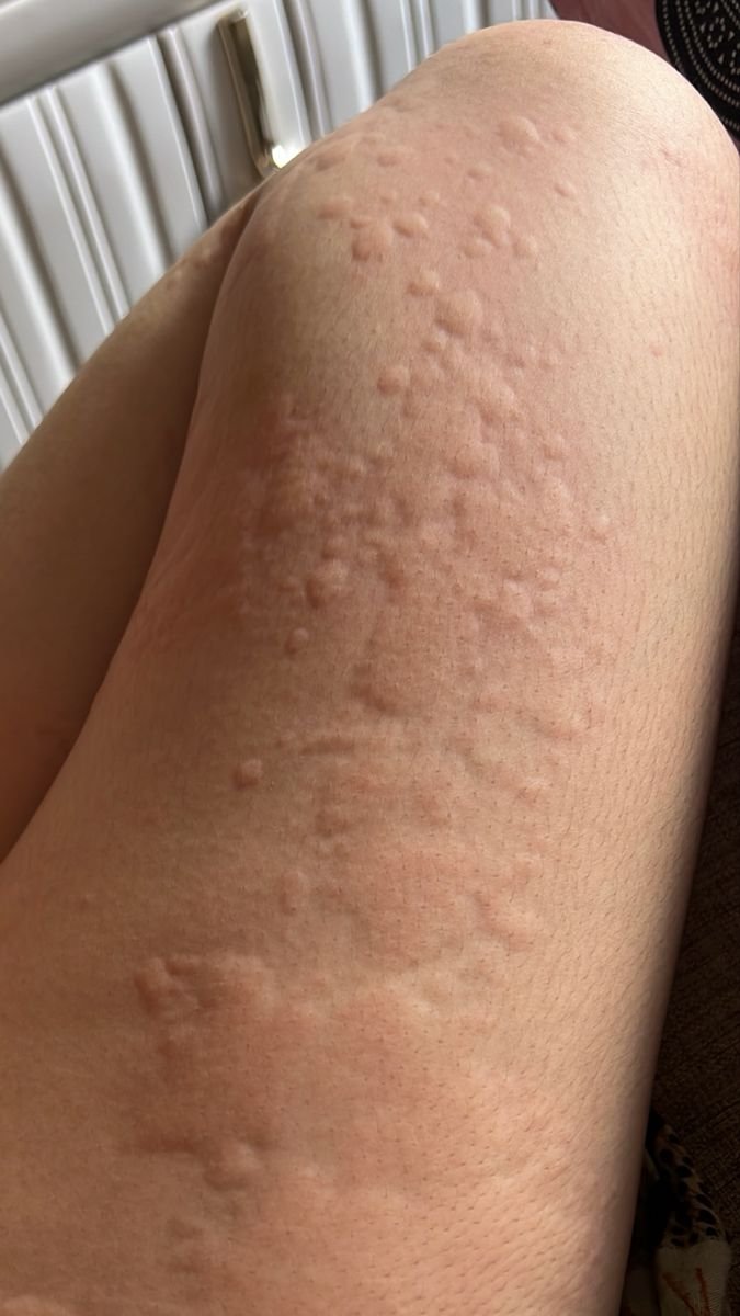 mama_biee's tweet photo. Ada yang sama gak sih kayak gini ? Tenang kalian ga sendirian guys.
Kalo lagi cuaca dingin langsung bentol2 seluruh badan tapi muka engga. https://t.co/FEKz4WN8X7