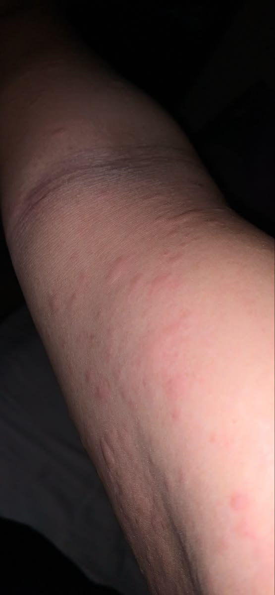 mama_biee's tweet photo. Ada yang sama gak sih kayak gini ? Tenang kalian ga sendirian guys.
Kalo lagi cuaca dingin langsung bentol2 seluruh badan tapi muka engga. https://t.co/FEKz4WN8X7