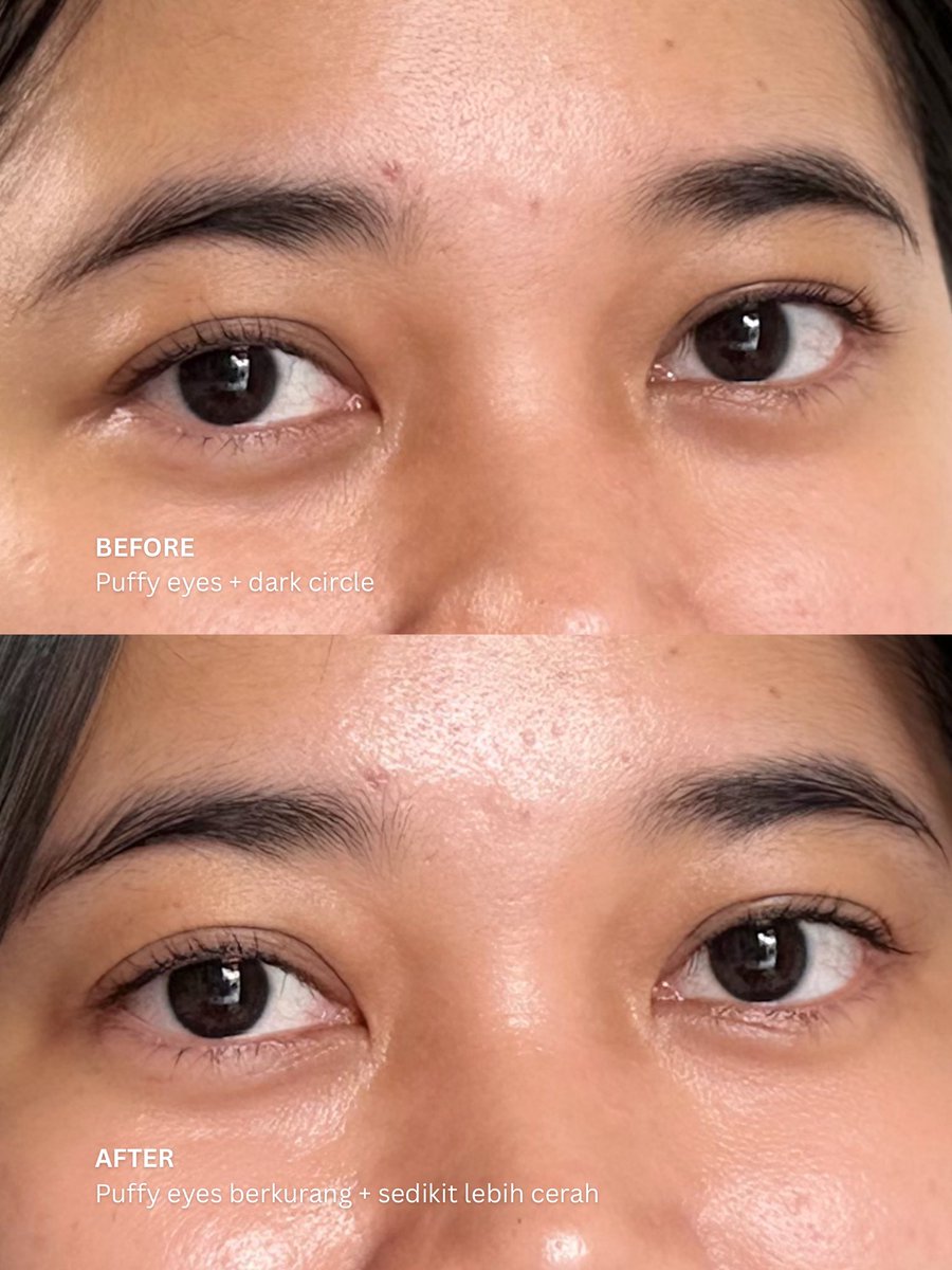 Mawrcellaa's tweet photo. Sering dibilang "habis nangis ya?" gara-gara mata bengep. Padahal ini tuh puffy eyes 😭

Untung sekarang jadi mendingan berkat rutin pakai eye serum ini 🥹✨￼ https://t.co/rKCsq6fngr