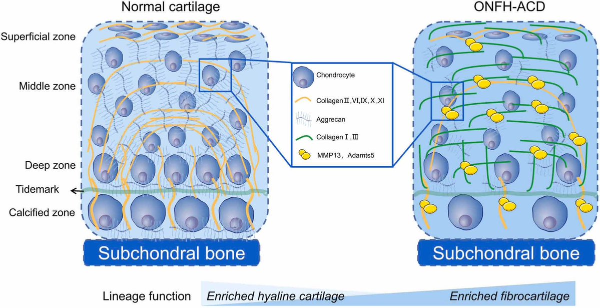 OACJournal's tweet photo. Zhu et al. investigated the role of Growth Differentiation Factor 10 (GDF10) in Osteonecrosis of the femoral head–associated cartilage degeneration (ONFH-ACD).  GDF10 limits fibrosis and supports cartilage matrix synthesis via SMAD1/5/8 and SMAD2/3. 
https://t.co/8wPpPrYcML https://t.co/MTNTEOhNEX