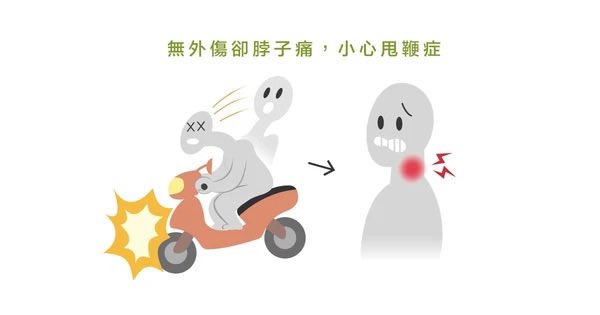 KCMAN417099's tweet photo. 醫生說我是車禍造成的甩鞭症

甩鞭症候群（Whiplash Syndrome，又稱頸部鞭打症）是當頭部受到外力（最常見於車禍被後車追撞、緊急煞車或劇烈碰撞）時，頸部因慣性作用而像甩鞭子一樣，發生急速的「向後過度伸展」與「向前過度彎曲」的劇烈甩動。 https://t.co/1p8gKhi9HO