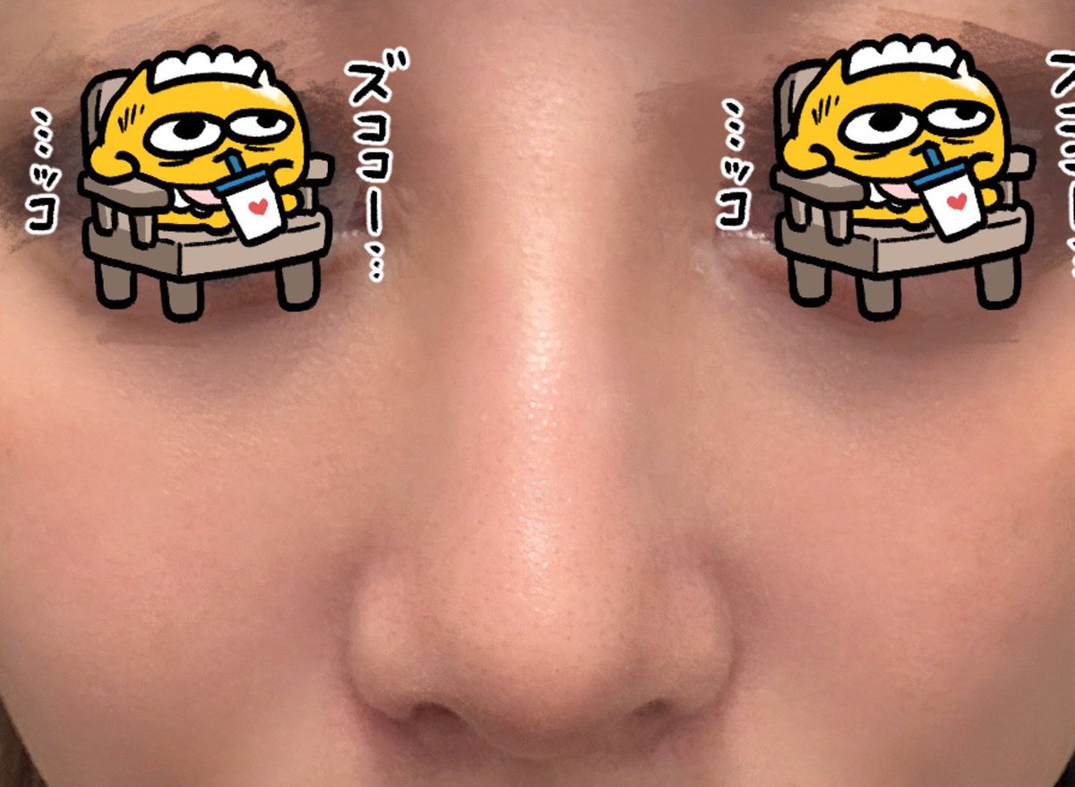 phbilq's tweet photo. 鼻フルdt初レポ　明日で二週間目
肌以外無加工です🙇🏻‍♀️
（肌が汚いため肌加工だけしてます🙏🏻）

施術内容は【鼻尖形成・耳介軟骨移植・肋軟骨移植・自家組織隆鼻・鼻孔縁挙上（左側のみ）】

毎日高さはすこしづつ落ち着いてきてるけど、完成形が全くわからなくてはやくdt終わってほしい😭 https://t.co/wGJMQFQAZS
