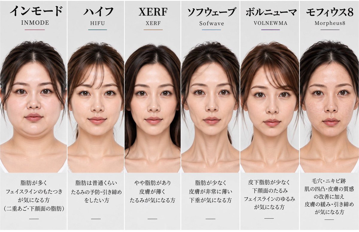 nm4xh5's tweet photo. 【悲報】ほうれい線・たるみ治療、顔によっては逆に老ける。

① インモード
ガリガリ面長・頬コケ顔は❌
脂肪を減らす施術では頬コケが加速。たるみ改善どころか骸骨顔になることも。

② ハイフ
頬コケ顔・ブルドッグ顔は❌
脂肪減少でコケが悪化することも。逆に皮膚が余りすぎた重度のたるみは改善しきれない。

③ XERF（ザーフ）
皮膚ダルダルの重度たるみ顔は❌
高周波で引き締めても余った皮膚は消えない。切開リフト級の変化を期待するとガッカリ。

④ ソフウェーブ
脂肪パンパンの二重顎は❌
得意なのは皮膚の引き締め。脂肪そのものを大量に減らしたい人には不向き。

⑤ ボルニューマ
頬がコケた骨ばった顔は⚠️
照射方法によっては頬コケが目立つ可能性も。脂肪が少ない顔は適応の見極めが重要。

⑥ モフィウス8
皮膚ペラペラ・ガリガリ顔は❌
深い照射で脂肪が減ると頬コケが悪化。引き締めたつもりが老け顔になることも。

結論：たるみ治療は人気の機械を選ぶゲームじゃない。クリニックはメリットばかり宣伝するけど実は向いてない顔がある。