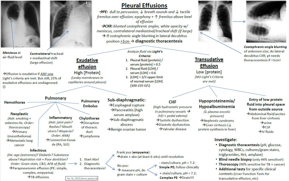 guidelinesMed's tweet photo. Pleural effusion https://t.co/U8Brql5zD3