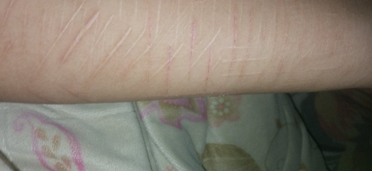 Inaisajoke's tweet photo. tis what my arm's looking like
#halloweenmakeup sfx makeup for scars idk https://t.co/iKYY1FO4DL