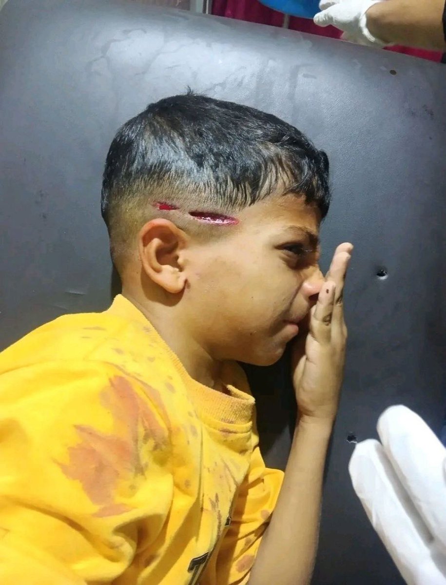 EyeonPalestine's tweet photo. A Palestinian child, Imad Salem Zahra, miraculously survived after being shot in the head by an Israeli occupation sniper east of Al-Bureij refugee camp in the central Gaza Strip. The incident highlights the targeting of Palestinian children and civilians by occupation snipers along the border areas.

نجا الطفل الفلسطيني عماد سالم زهرة بأعجوبة عقب أصابته مباشرة برصاص قناصة الاحتلال في الرأس، شرقي مخيم البريج وسط قطاع غزة. وتجسد هذه الحادثة الخطر والتهديد المستمر الذي يلاحق أطفال غزة والمدنيين جراء عمليات القنص والاطلاق المباشر للنار في المناطق الحدودية.