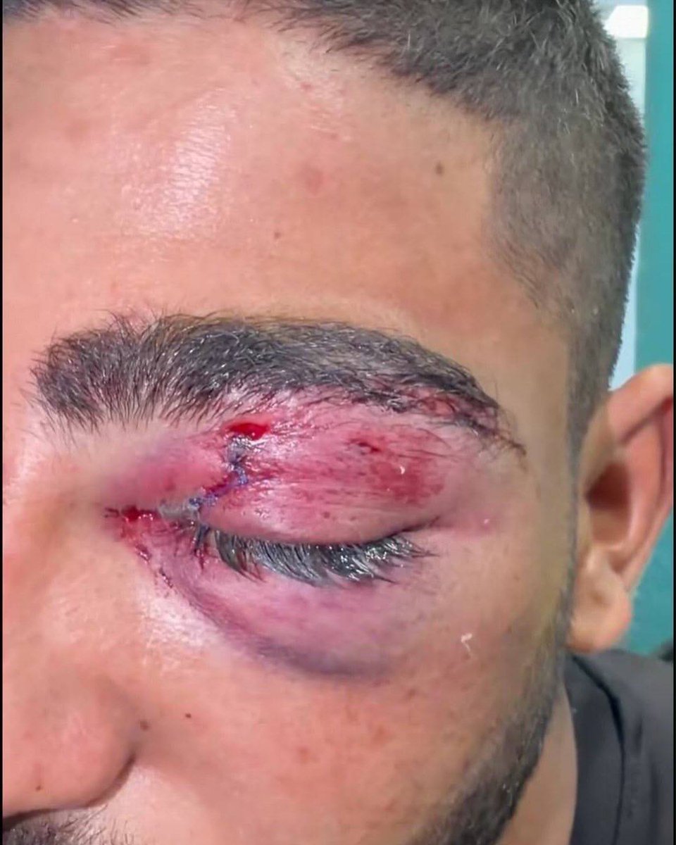 josepgoded's tweet photo. A young Palestinian man was brutally assaulted and injured by Israelis in Masafer Yatta today. https://t.co/3mk65uEjU5