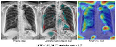 Radiology_AI's tweet photo. A new deep learning tool supports opportunistic screening for left ventricular dysfunction on chest X rays https://t.co/O97H60tSxY  #DeepLearning #Prescreening #AI https://t.co/cJdbEVVsYk