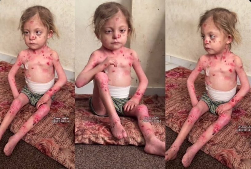 SondosMurtaja's tweet photo. Children of Gaza 💔🥹
Nour.

She suffers from a rare skin disease and malnutrition.

There is no medicine for her. There is no food for her.

She will die soon unless these borders are opened! https://t.co/SsGd4Z5b8G