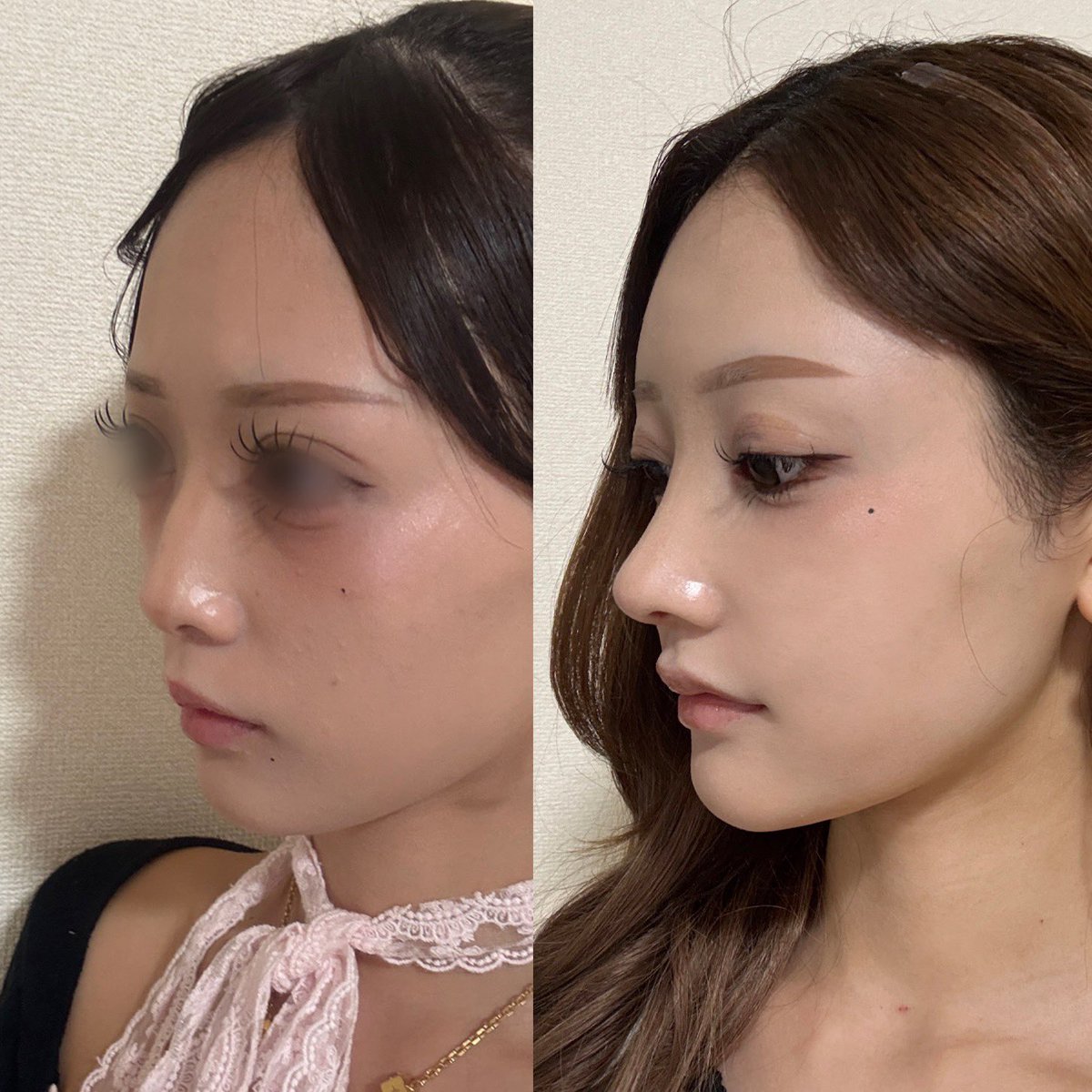 x_h_ll29's tweet photo. 抜糸するまでは不安だったけど実際に仕上がりを見たら想像以上に綺麗で本当に満足🥹まだ腫れ残ってて完成形ではないけど、カウンセリングの段階から施術後までオ院長に丁寧にしてだいて、仕上がりは本当に大満足♡ 鼻整形と脂肪移植、Cカール形成も一緒に受けたけど本当にやってよかった😭天才✨ https://t.co/t4ini3Sk3P