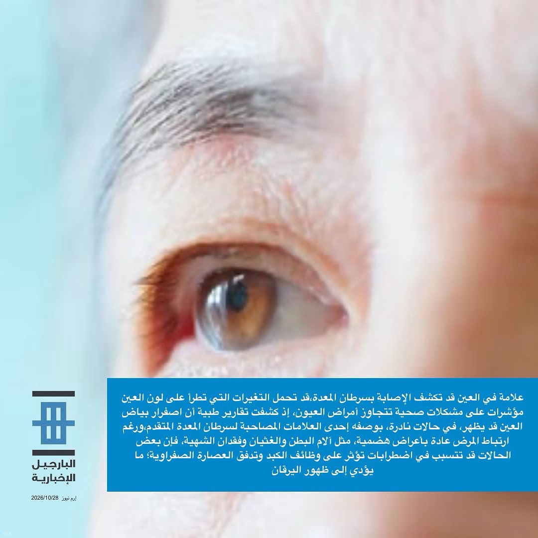 علامة في العين قد تكشف الإصابة بسرطان المعدة،قد تحمل التغيرات التي تطرأ على لون العين مؤشرات على مشكلات صحية تتجاوز أمراض العيون، إذ كشفت تقارير طبية أن اصفرار بياض العين قد يظهر، في حالات نادرة، بوصفه إحدى العلامات المصاحبة لسرطان المعدة المتقدم،ورغم ارتباط المرض عادة بأعراض هضمية، مثل آلام البطن والغثيان وفقدان الشهية، فإن بعض الحالات قد تتسبب في اضطرابات تؤثر على وظائف الكبد وتدفق العصارة الصفراوية؛ ما يؤدي إلى ظهور اليرقان 